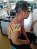 贵州贵阳针灸培训温针疗法